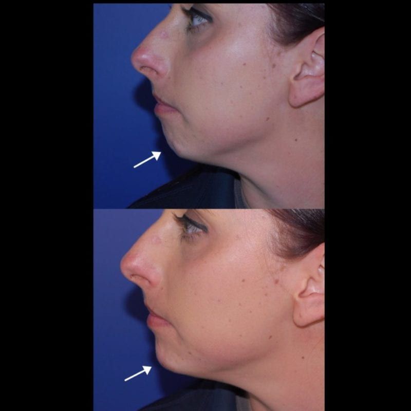 Chin Filler Before and after